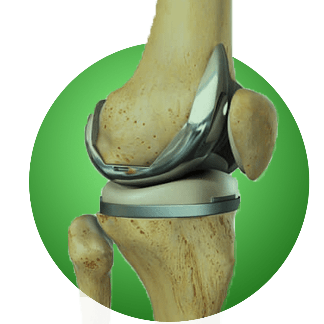 Knee Replacement Surgery: Recovery And Rehabilitation | #KhabarLive ...